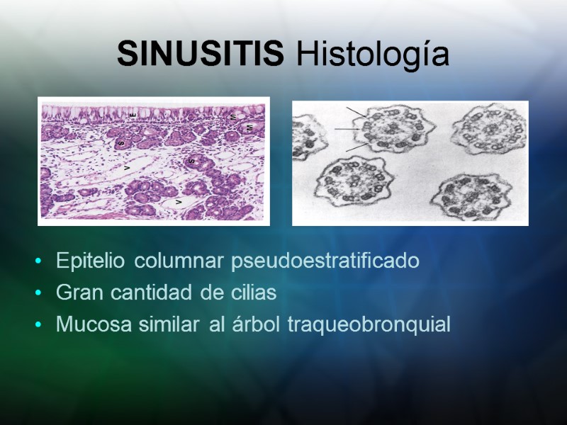 SINUSITIS Histología Epitelio columnar pseudoestratificado Gran cantidad de cilias Mucosa similar al árbol traqueobronquial